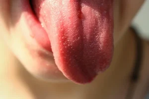 صورة توضح علاج ثقل اللسان