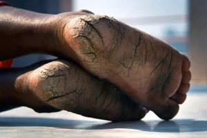 صورة توضح أسباب متلازمة الضائقة التنفسية
