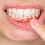 كيف اتخلص من التهاب اللثة بسرعة