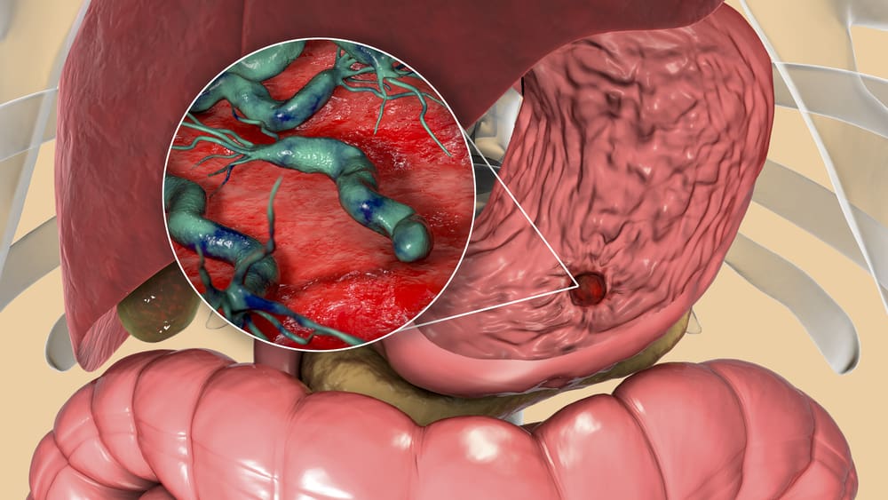 Helicobacter pylori