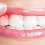 ما علاج التهاب اللثة سريع المفعول