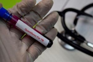 متى يتم اجراء اختبار TB
