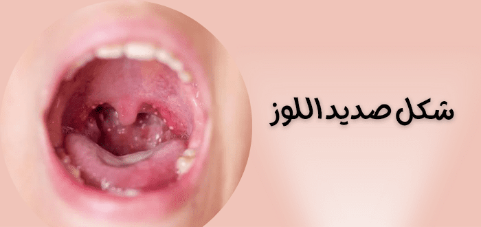 شكل صديد اللوز بالصور