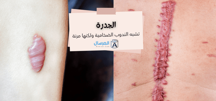 أنواع الندبات