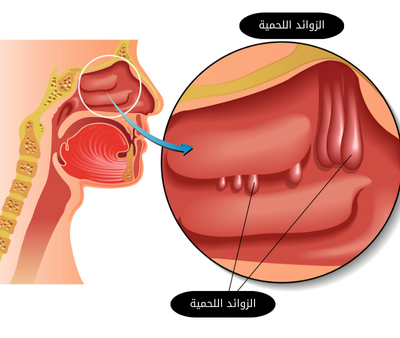 لحمية الأتف بالصور