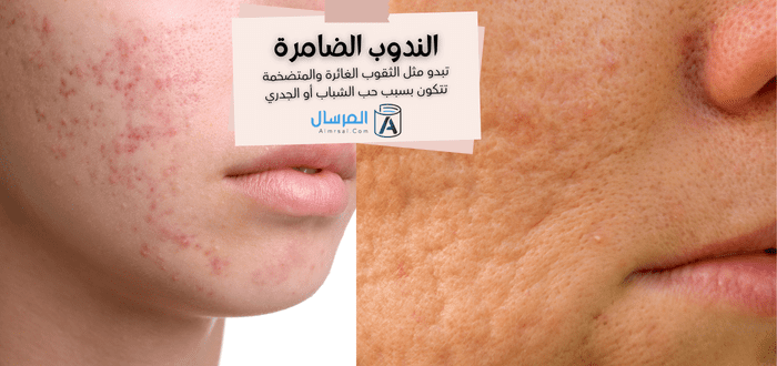 أنواع الندبات