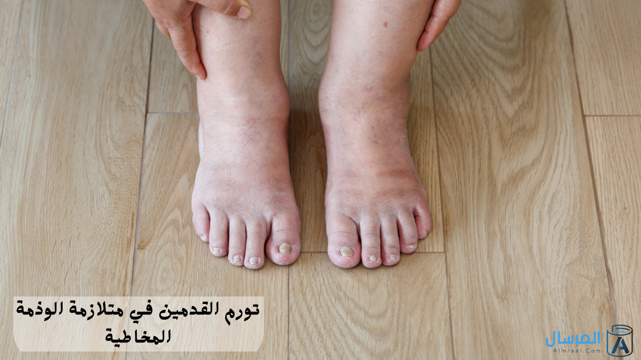 تورم القدمين في متلازمة الوذمة المخاطية