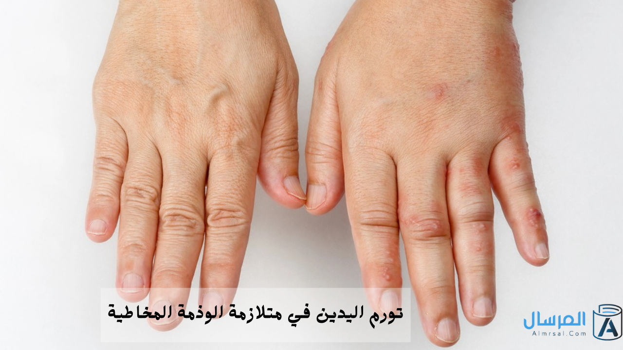 تورم اليدين في متلازمة الوذمة المخاطية