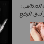 درجات لين العظام متى يظهر لدى الرضع