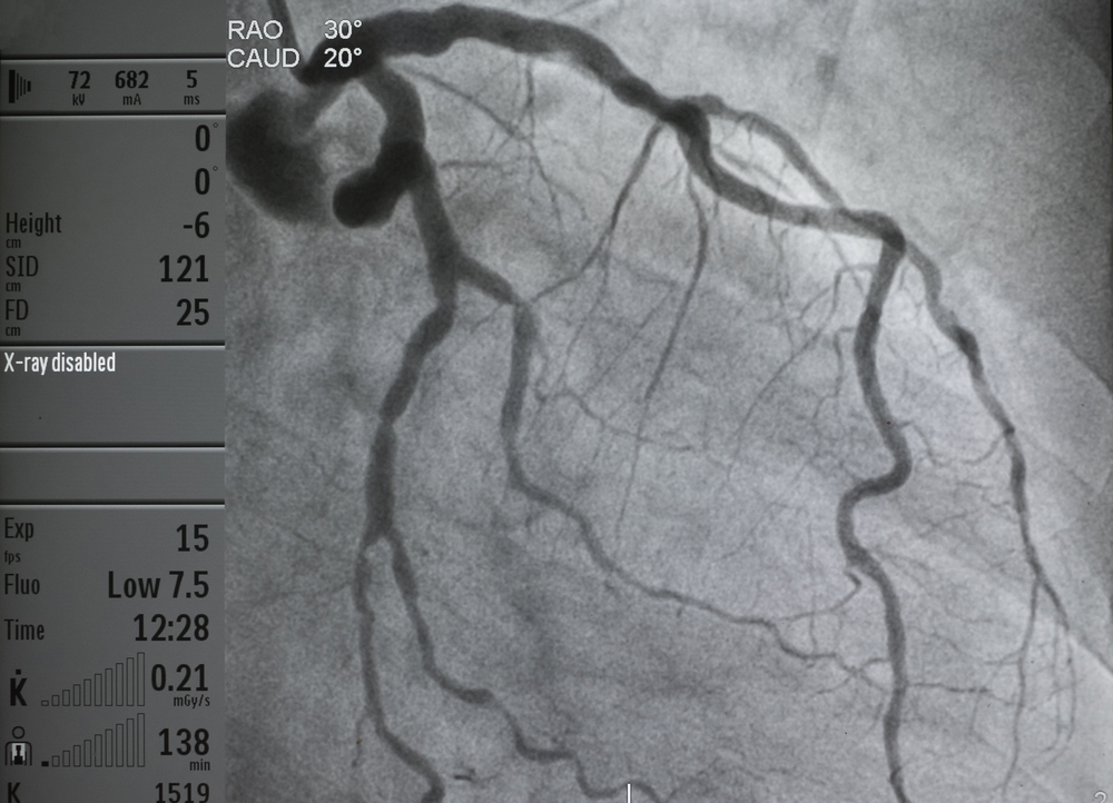 Coronary angiography