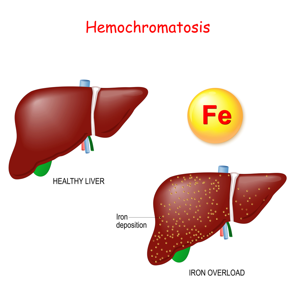 Hemochromatosis or Iron overload. Healthy liver and liver with iron deposits. genetic disorder. comparison, and differences