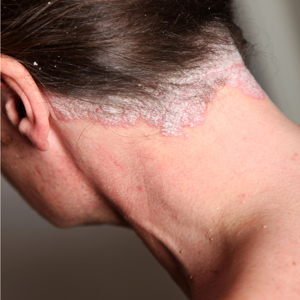 Severe psoriasis