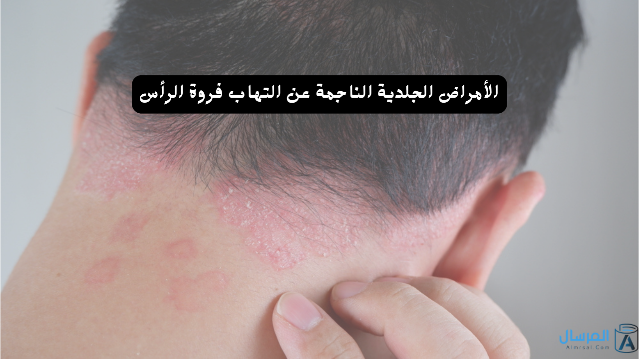 الأمراض الجلدية الناجمة عن التهاب فروة الرأس
