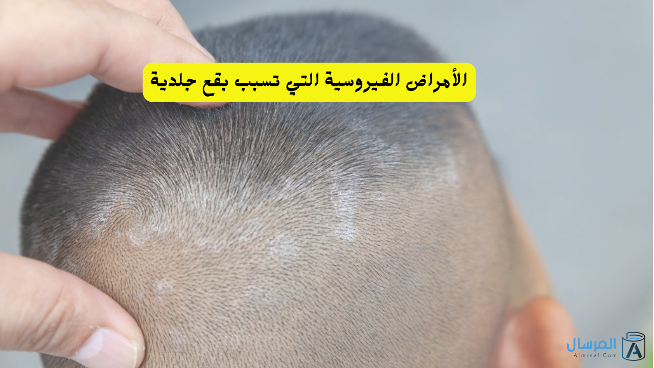 الأمراض الفيروسية التي تسبب تقرحات الجلد