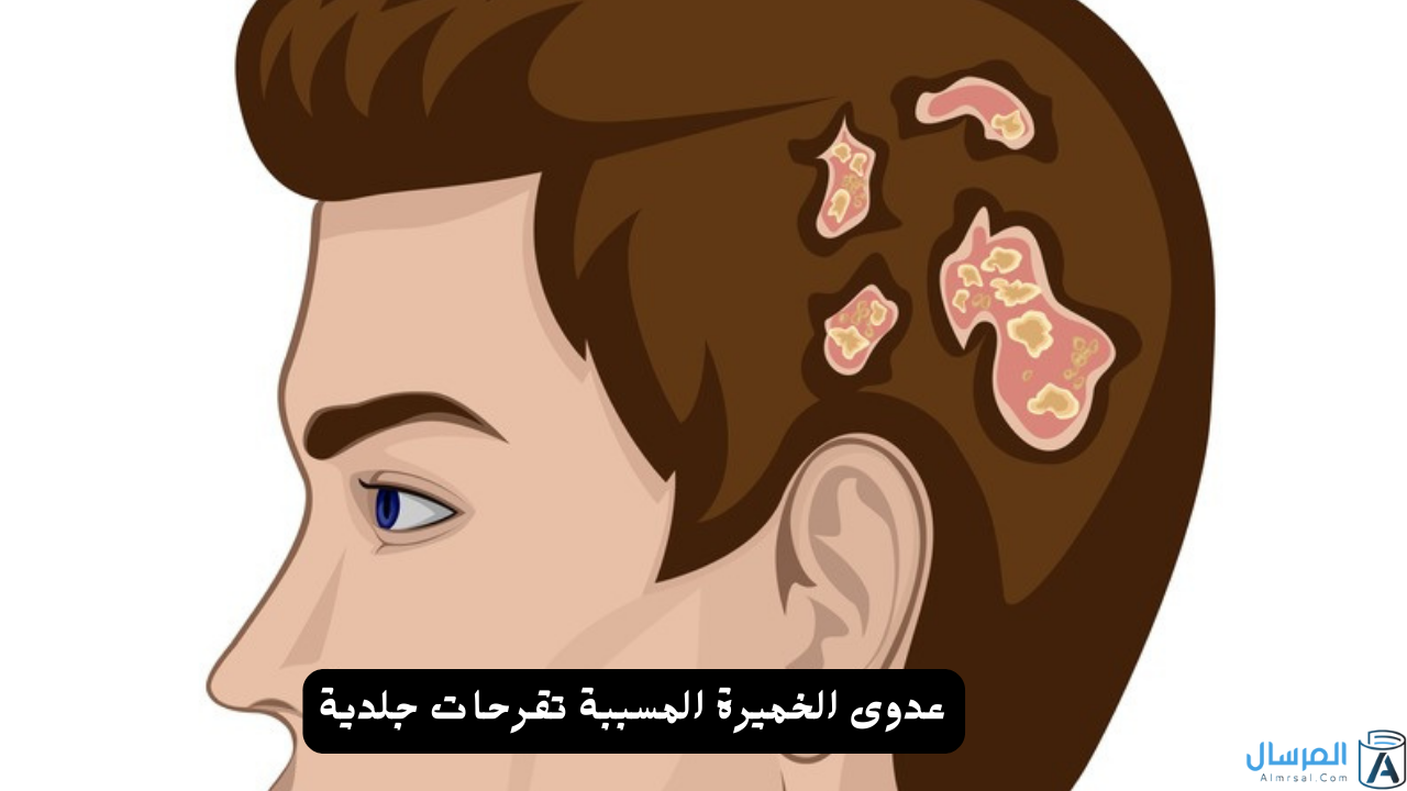 عدوى الخميرة المسببة تقرحات جلدية