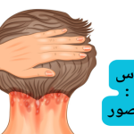 فروة الرأس الملتهبة شكلها بالصور