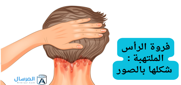 فروة الرأس الملتهبة شكلها بالصور