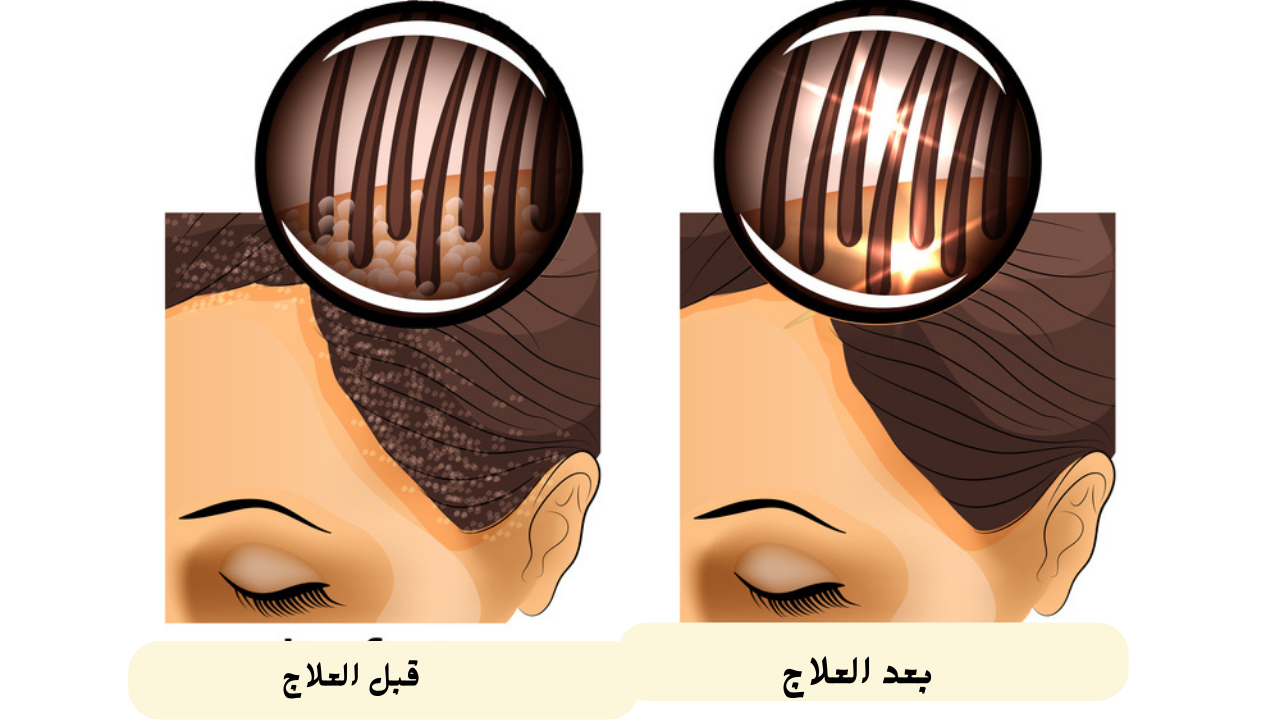 العلاجات الخاصة بفروة الرأس