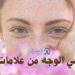 النمش في الوجه من علامات الجمال : صفات شخصيتهم