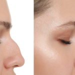 تجميل الأنف غير الجراحي: التقنيات والآليات