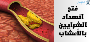 فتح انسداد الشرايين بالأعشاب الحقيقة وتصحيح الأخطاء