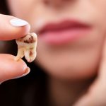 تسوس الاسنان تغير فيزيائي ام كيميائي