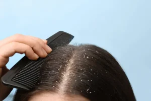 نزع القشرة من الشعر في المنام للمتزوجة التفسير الكامل