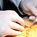 هل سحب خيوط العملية القيصرية مؤلم