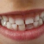 اختلاف شكل الاسنان وأهميته
